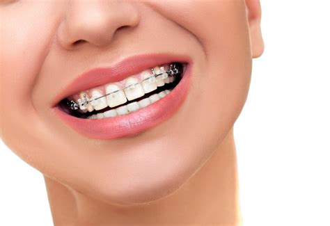 16 Myths And Facts About Braces Bracesetters