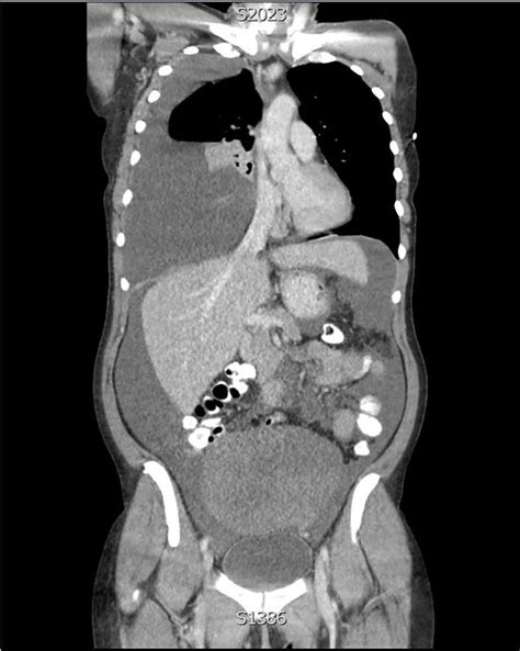 Breathlessness And Abdominal Swelling A Classic Eponymous Syndrome