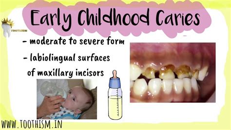 Early Childhood Caries Types Of Ecc Prevention Levels Management
