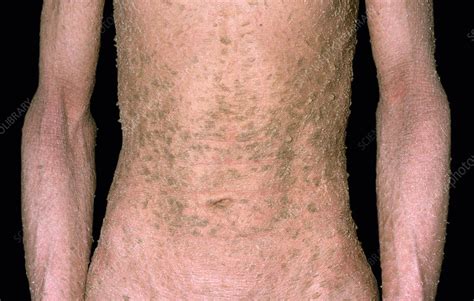 Ichthyosis Stock Image C0459540 Science Photo Library