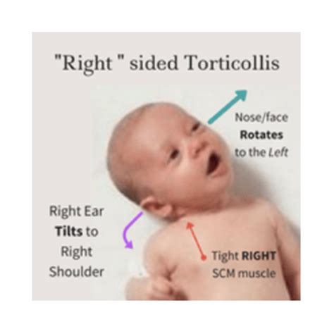 Infant Torticollis Hempstead Therapy Centre