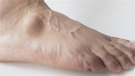 What Does Cancer On The Bottom Of Your Foot Look Like Foot Melanoma