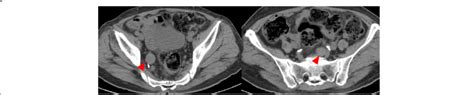Ct Image Of The Lymphadenopathy Around The Rectum Arrow Heads Show The