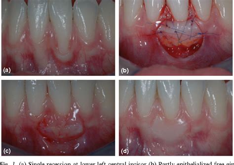 Pdf The Partly Epithelialized Free Gingival Graft Pe Fgg At Lower
