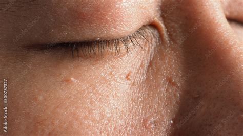 Wart Skin Removal Macro Shot Of Warts Near Eye On Face Papilloma On