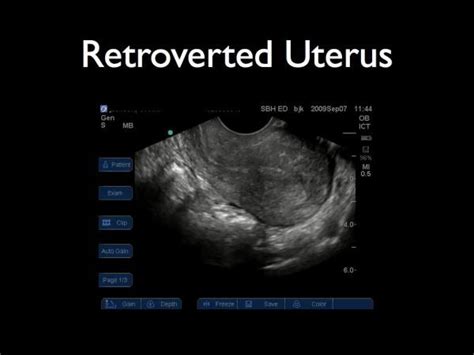 Retroverted Retroflexed Uterus Retroflexed Vs