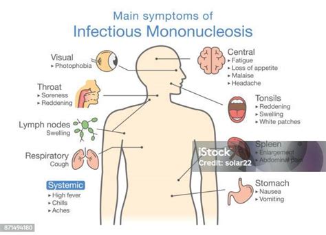 Vetores De Sintomas Da Doença De Mononucleose Infecciosa E Mais Imagens