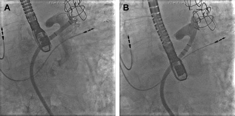 The Watchman Left Atrial Appendage Closure Device Interventional