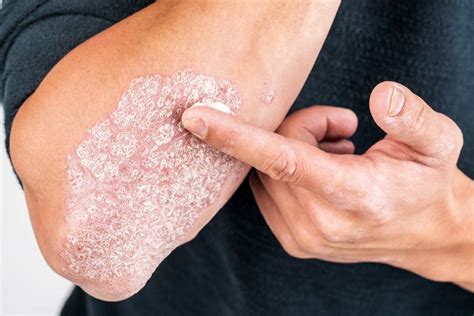 Your Health Psoriasis Is More Than Skin Deep Central Western Daily