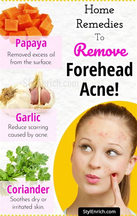 Forehead Acne How To Get Rid Of Acne With Top 5 Home Remedies