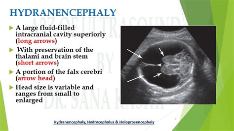 Hydranencephaly Fluid Filled Fetal Brain Differentials A2z Of