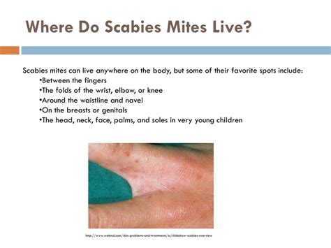 Ppt What Is Scabies Powerpoint Presentation Free Download Id2457230