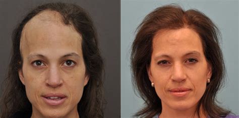 Hair Restoration In A Female Patient Post Craniotomy And Radiation