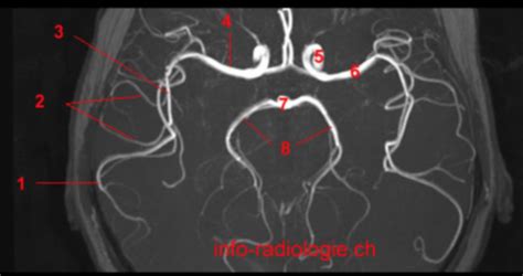 Mri Of The Brain Time Of Flight Axial Mip Circle Of Willis Magnification Internal