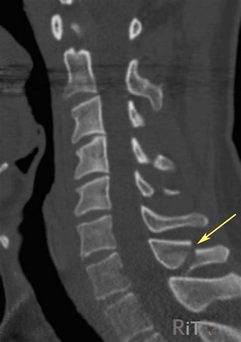 Transverse Process Fracture X Ray