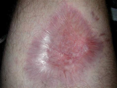 Brown Recluse Spider Bite Causes Symptoms Treatment Pictures Of