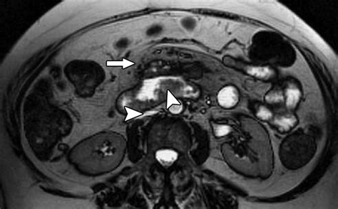 Mr Enterography Of Small Bowel Lymphoma Potential For Suggestion Of