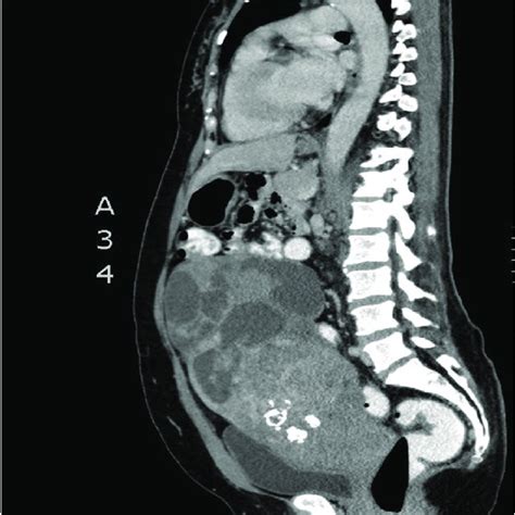 Pelvic Mri Showing A Huge Uterine Mass And A Left Adnexal Complex Cyst