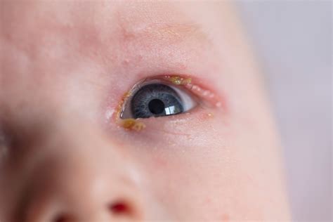 What Is Conjunctivitis In Children Types Treatment And More