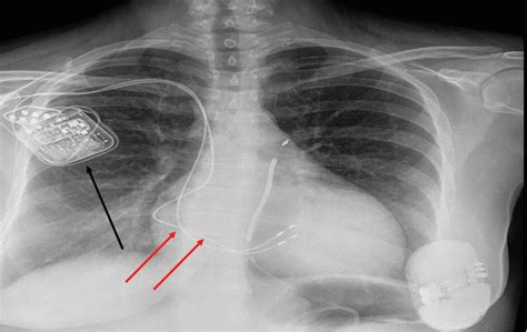 An Example Of The Optimizer Smart Implant In A Female Patient With A