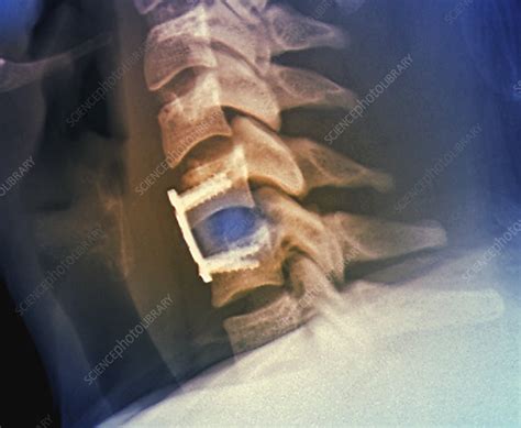 Cervical Vertebral Implant And Repair X Ray Stock Image C0403343