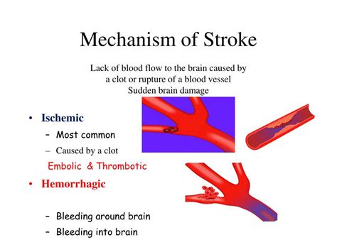 Ppt Stroke Powerpoint Presentation Free Download Id2219101
