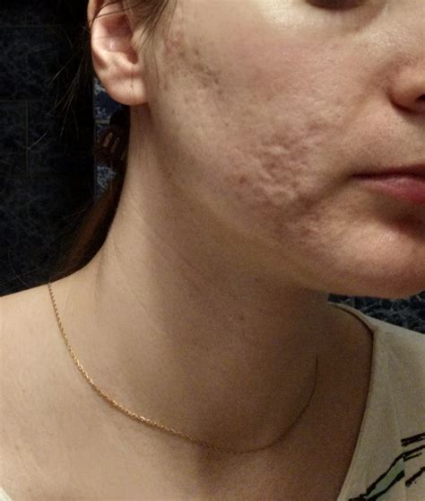 Severe Rollingbox Scars What To Try Next Pics Scar Treatments