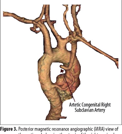 Figure 3 From A Review Of Subclavian Steal Syndrome With Clinical