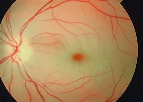 Macular Cherry Red Spot Causes Symptoms And More