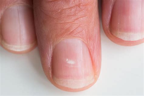 Suffer With White Marks On Your Fingernails This Is What They Mean