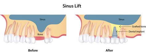 Sinus Lift Surgery Before Dental Implants San Antonio Tx