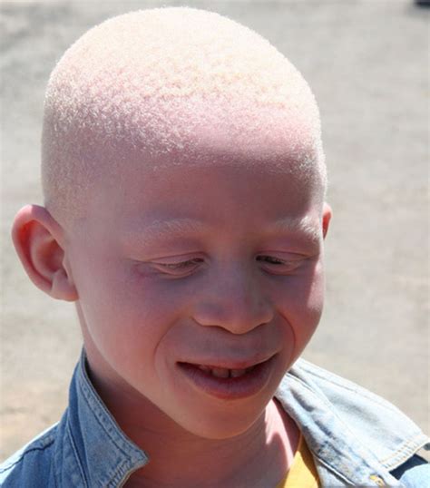 What Is Albinism The Fear And Threats Of Albinos In Africa