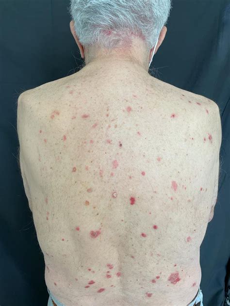 Recurrence Of Multiple Psoriatic Plaques Scaly Erythematous And