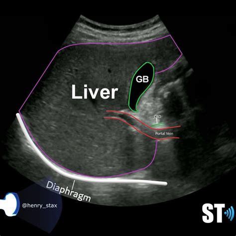 Liver Anatomy And Protocol Basics Sonographic Tendencies Ultrasound Sonography Medical