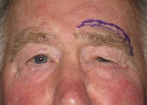 Drooping Eyebrows Brow Lift Surgery Mr David Cheung Eyelid Specialist Birmingham UK