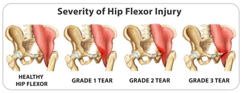 Understanding the differences among the hip flexor five muscles can help you prevent or alleviate back you can see how important this is for athletic performance, because low back pain and strains are serious problems. Left hip ache when sitting, hip strain treatment