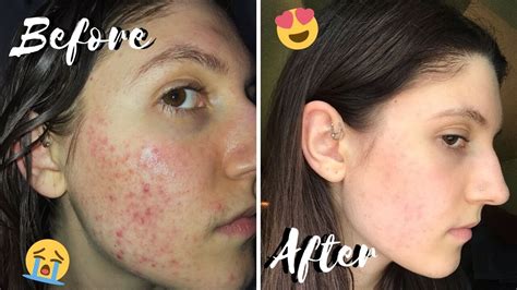 Curing My Hormonal Acne Naturally Youtube