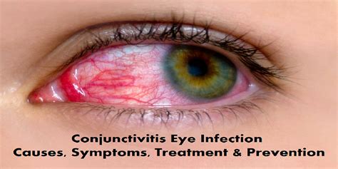 Conjunctivitis Eye Infection Causes Symptoms Treatment And Prevention
