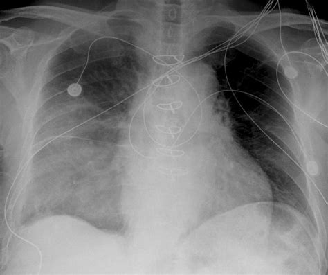 More likely to contain dystrophic calcification 2. Malignant Thymoma - radRounds Radiology Network