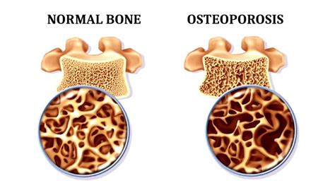 What Are The Symptoms Of Osteoporosis