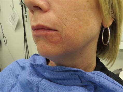 Complication From Lip Biopsy For Sjogrens With Mucocele Formation