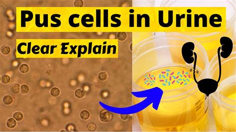 Pus Cells In Urine Microscopic Photosclear Explain Youtube