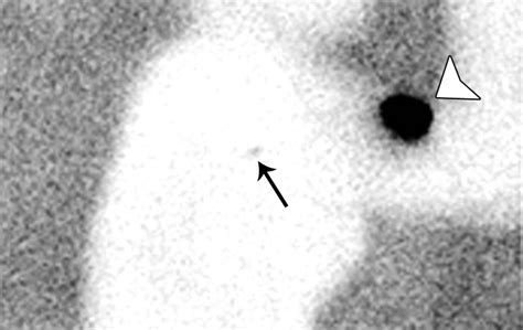 Lymphoscintigraphy In Cutaneous Melanoma An Updated Total Body Atlas