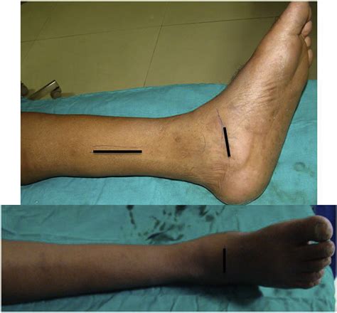 Tibialis Posterior Tp Tendon Transfer For Foot Drop A Single Center
