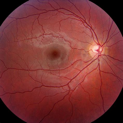 Normal_retina.002_750_web | Wills Eye Hospital