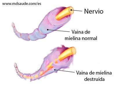 Conoce más sobre este padecimiento que afecta al cantante vicente fernández. Enfermer@ en Urgencias y UCI : Síndrome de Guillain-Barré