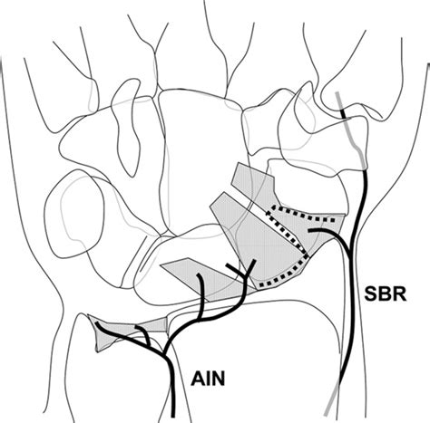 Figure 4 From Nerve Sparing Dorsal And Volar Approaches To The