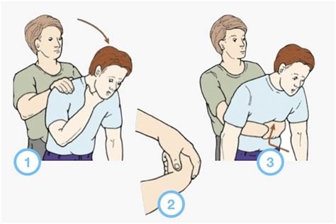 C Mo Realizar La Maniobra De Heimlich Maestria Salud