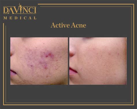 Da Vinci Clinic Acne Scars Treatment Using Fotona Sp Dynamis Pro Laser