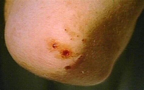 Yeast Infection Elbow Guide